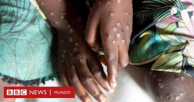 Mpox (antes viruela del mono): la infección no es una nueva covid y puede ser contenida, dice la OMS - BBC News Mundo